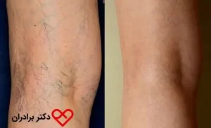 treat varicose veins